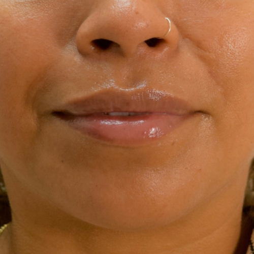 Dermal Filler