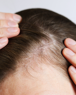 Hair Loss & Thinning