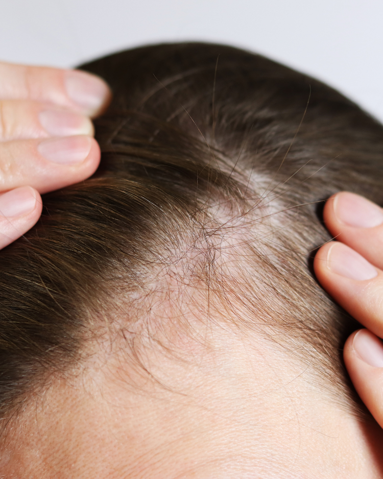 Hair Loss & Thinning