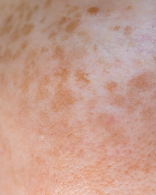 Hyperpigmentation & Sun Damage