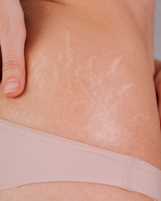 Scarring (Acne, Surgical, Stretchmarks)