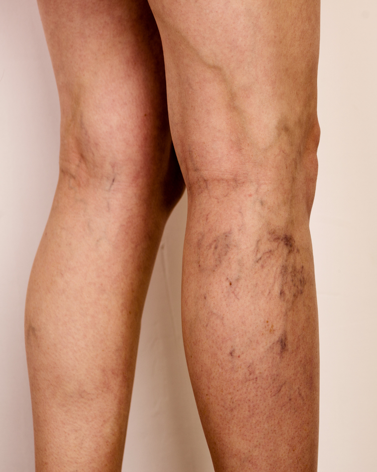 Vascular & Veins (Telangiectasia, Spider Veins)