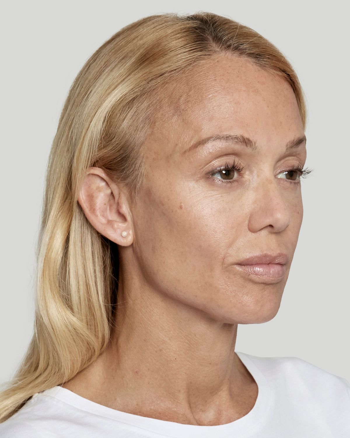 Sculptra before and after female 6 months after treatment after photo