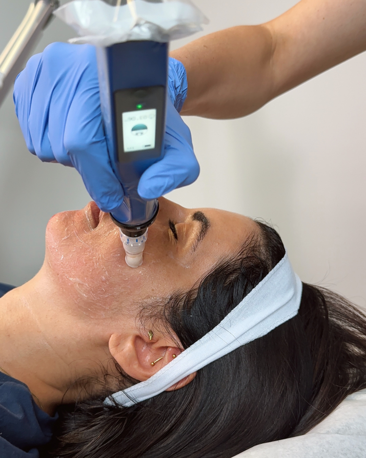 Skinpen Microneedling