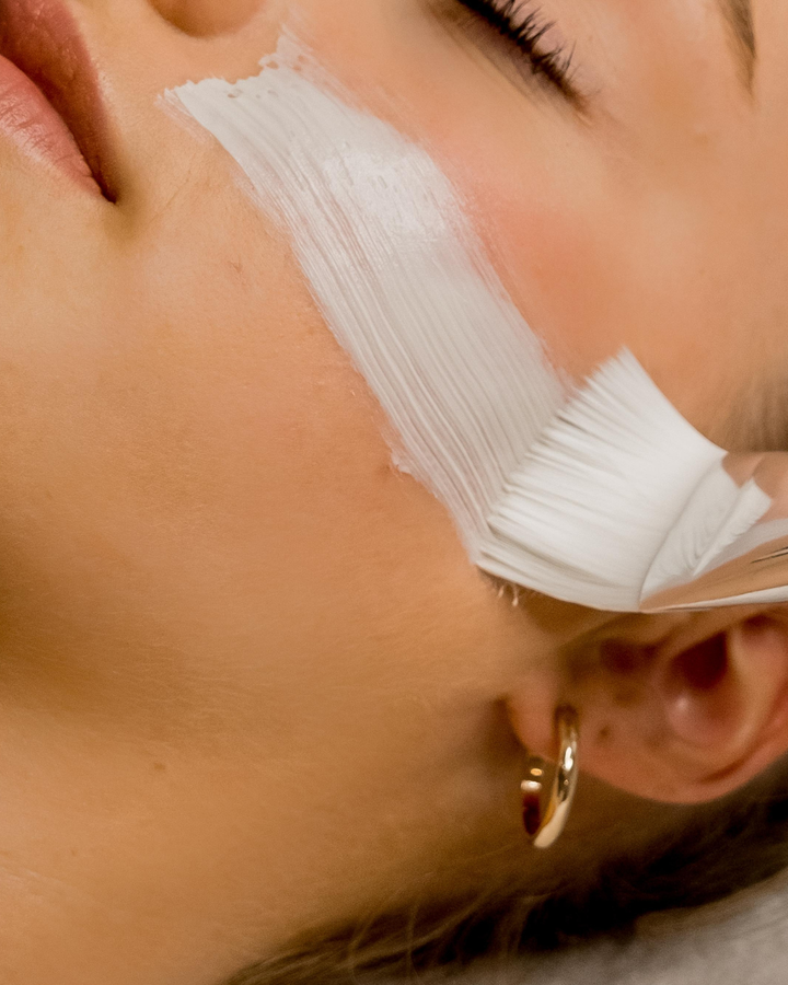 Chemical Peels (Salicylic, Glycolic, Jessner’s, Combination)