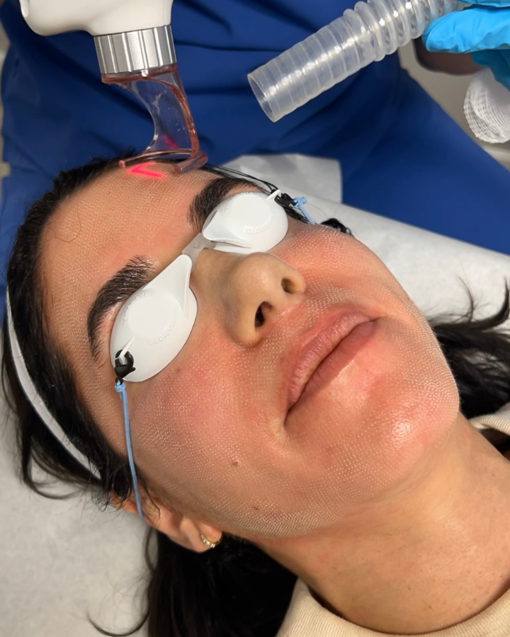 CO2 Ablative Laser (Secret PRO)