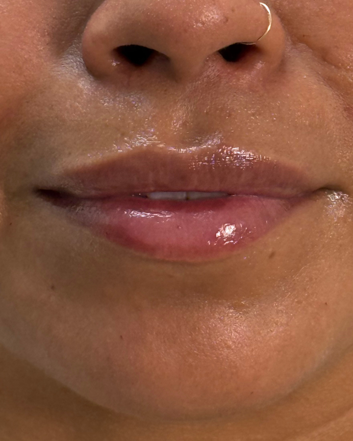 Dermal Fillers (Juvederm + Restylane)