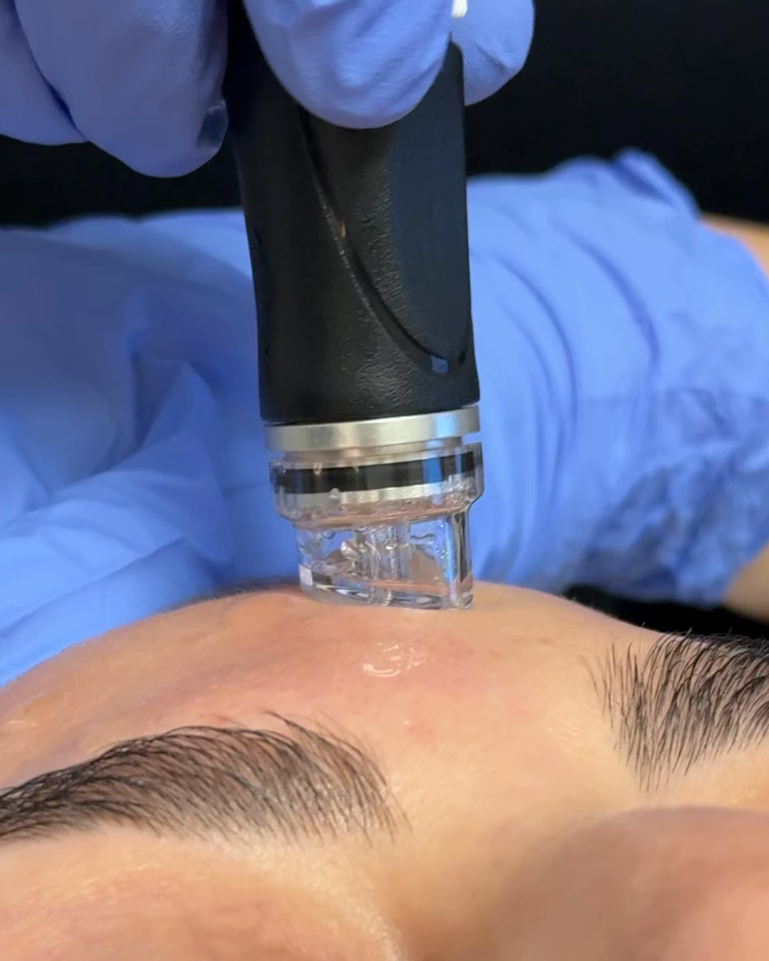 HydraFacial