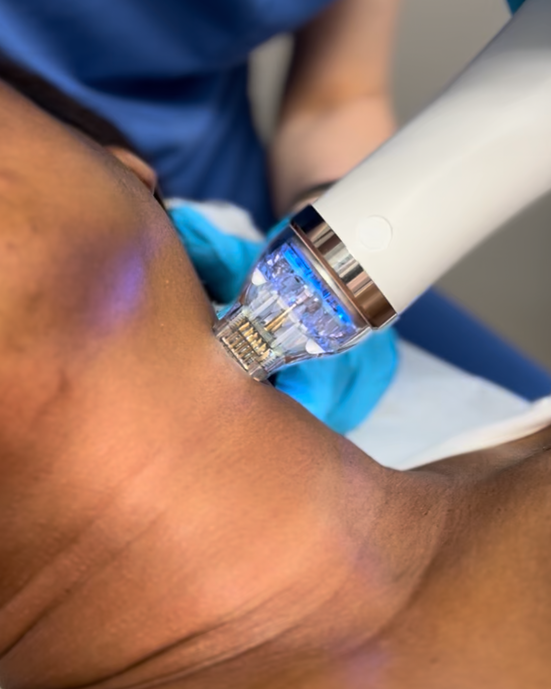 RF Microneedling (Cutera Secret PRO)