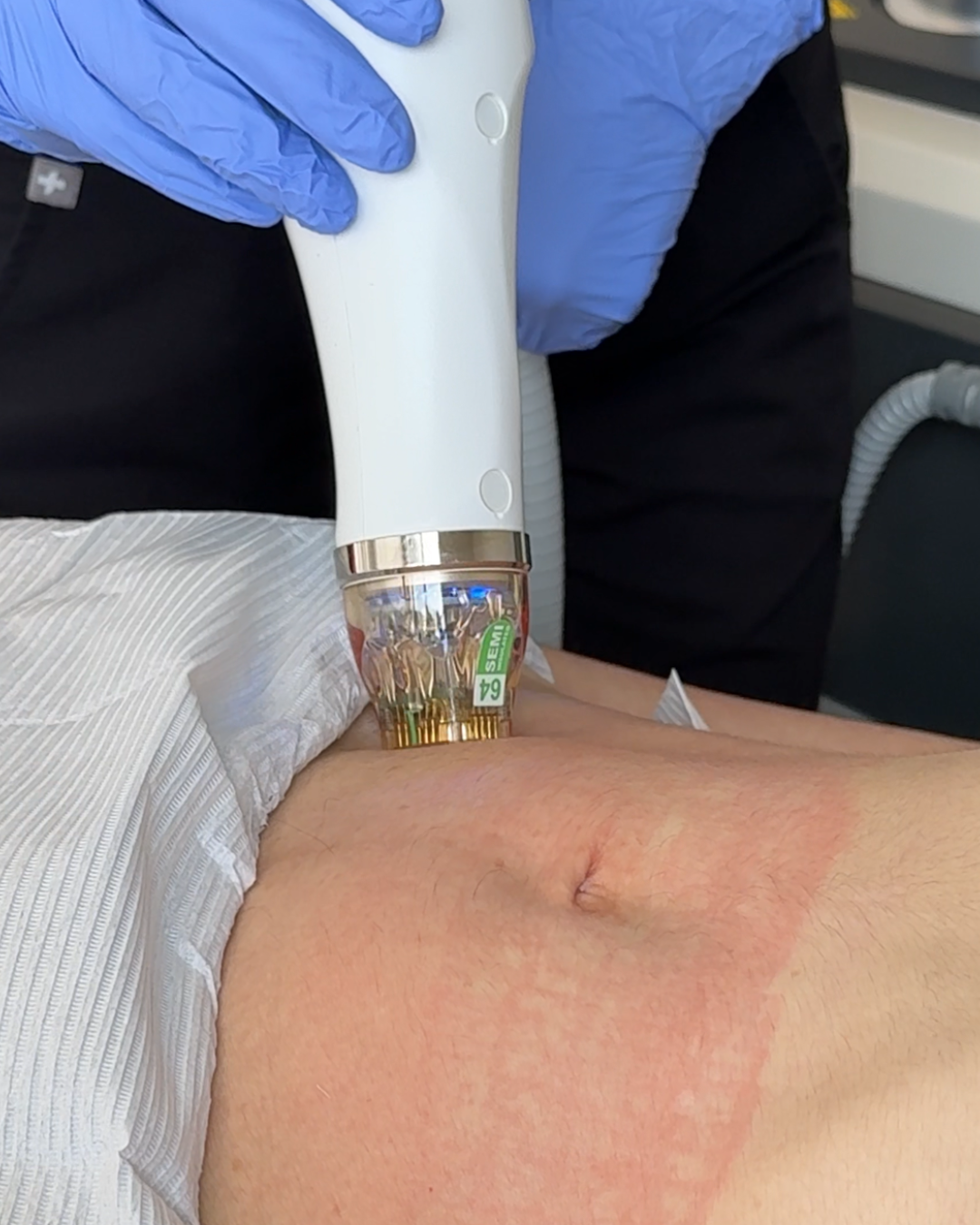 RF Microneedling (Cutera Secret PRO)