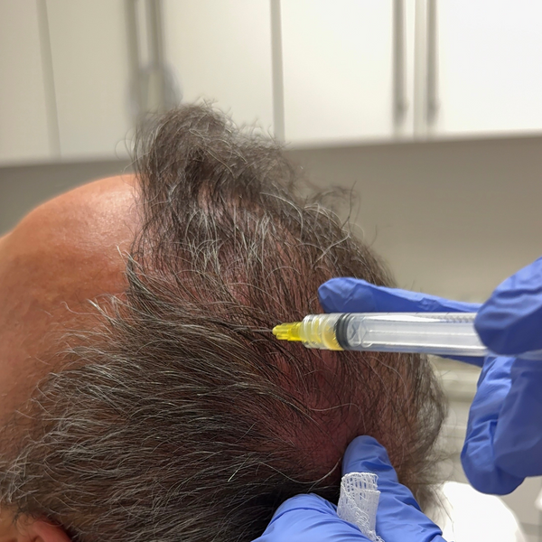 PRP treatment for hair loss being performed by Yekaterina Kleydman, a board certified dermatologist in NYC