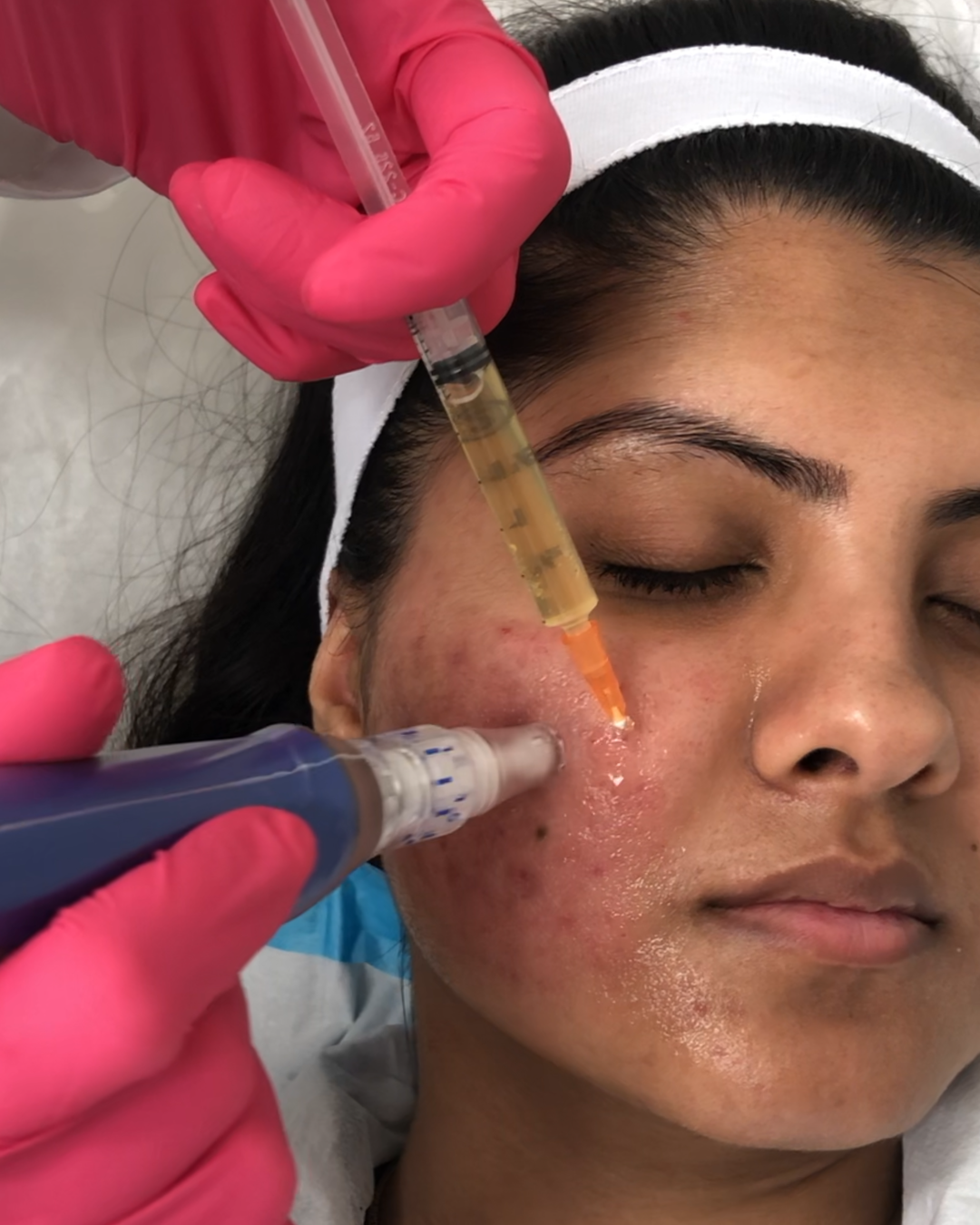 Skinpen Microneedling