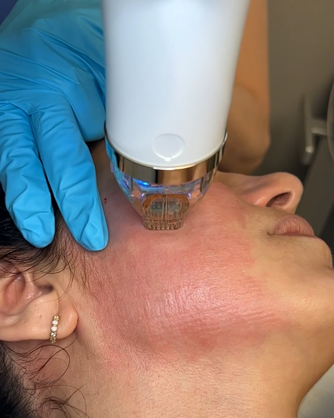 RF Microneedling (Cutera Secret PRO)