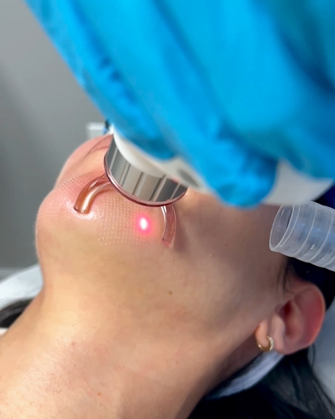 CO2 Ablative Laser (Secret PRO)