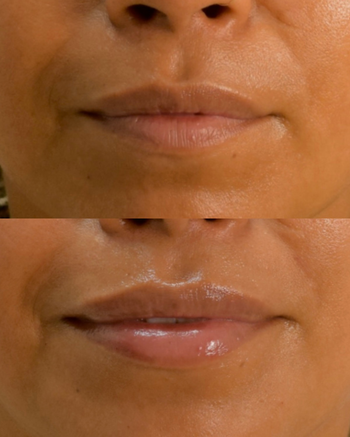 Dermal Fillers | Juvederm & Restylane