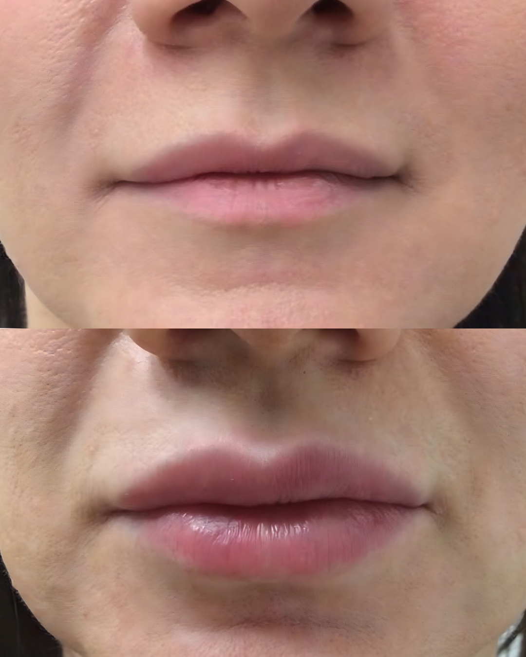 Dermal Fillers (Juvederm + Restylane)