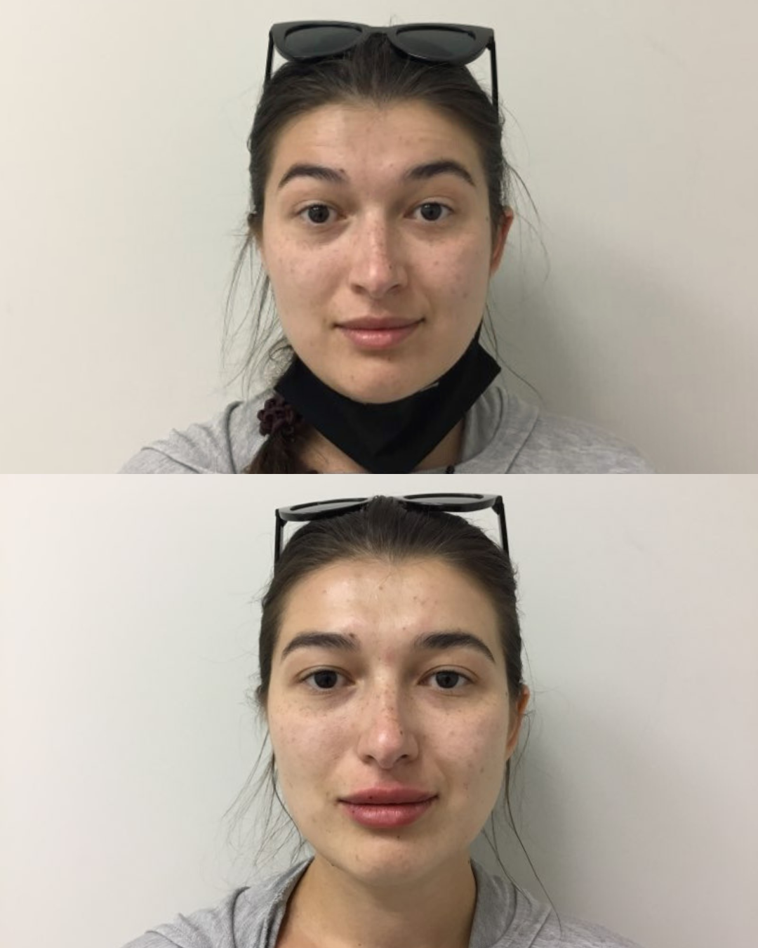 Dermal Fillers (Juvederm + Restylane)