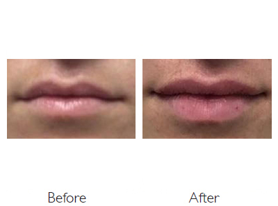 Dr. Yekaterina Kleydman - Before & After | Kleydman Dermatology ...